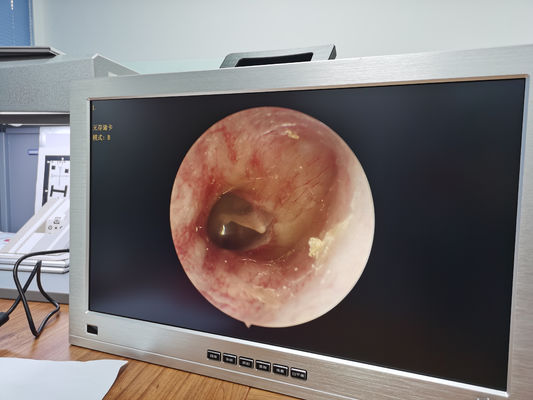 Il monitor a 22 pollici ha integrato il portatile pieno OTORINOLARINGOIATRICO dell'insieme del sistema della macchina fotografica dell'endoscopio di HD